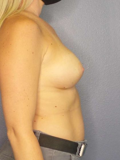 Breast Augmentation Revision (Breast Enlargement Repair) Before & After Patient #7212