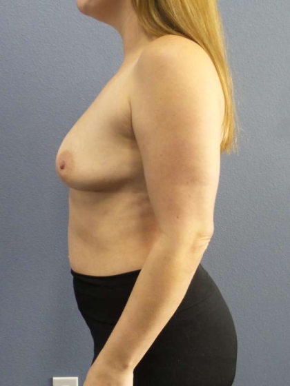 Breast Lift with Implant (Augmentation Mastopexy) Before & After Patient #4427