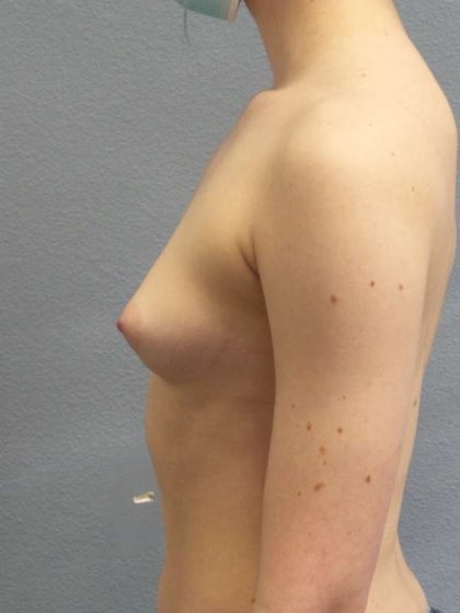 Breast Augmentation Before & After Patient #5296