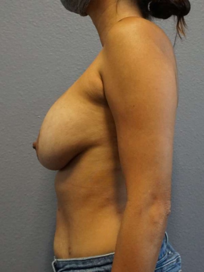 Augmentation Mastopexy Revision Before & After Patient #4746