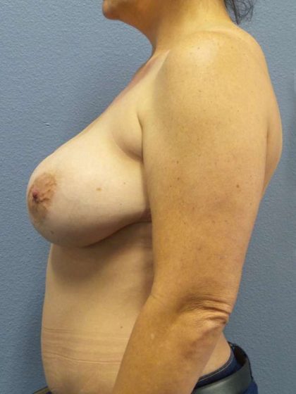 Breast Lift with Implant (Augmentation Mastopexy) Before & After Patient #4220