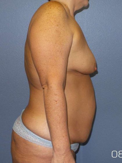 Breast Lift with Implant (Augmentation Mastopexy) Before & After Patient #4013