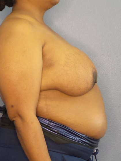 Mastopexy (Breast Lift) Before & After Patient #8402