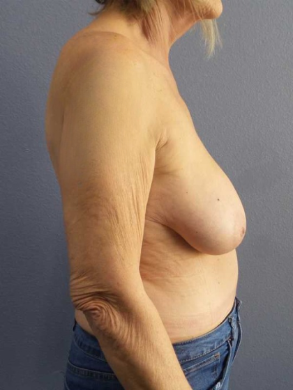 Breast Reduction Before & After Patient #7487
