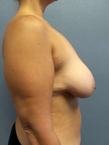 Breast Lift with Implant (Augmentation Mastopexy) Before & After Patient #4066