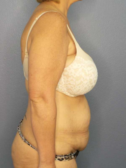 High BMI (Larger Patients) Surgery Before & After Patient #10438
