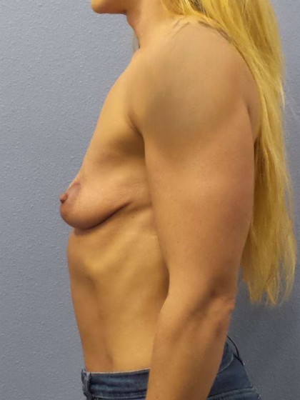 Breast Augmentation Before & After Patient #6589