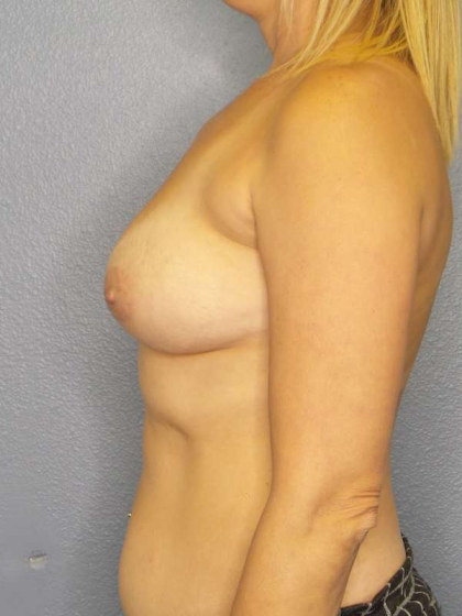 Breast Augmentation Before & After Patient #5502