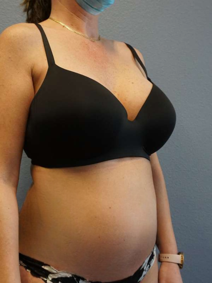 Liposuction Female Before & After Patient #8101