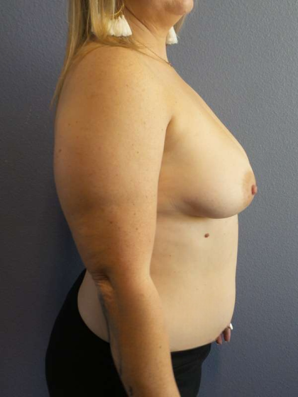 Breast Augmentation Before & After Patient #6208