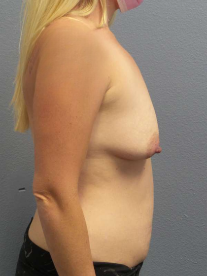 Breast Lift with Implant (Augmentation Mastopexy) Before & After Patient #4542