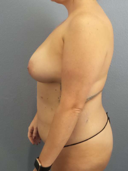 Breast Lift with Implant (Augmentation Mastopexy) Before & After Patient #4509