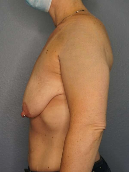 Breast Lift with Implant (Augmentation Mastopexy) Before & After Patient #3989