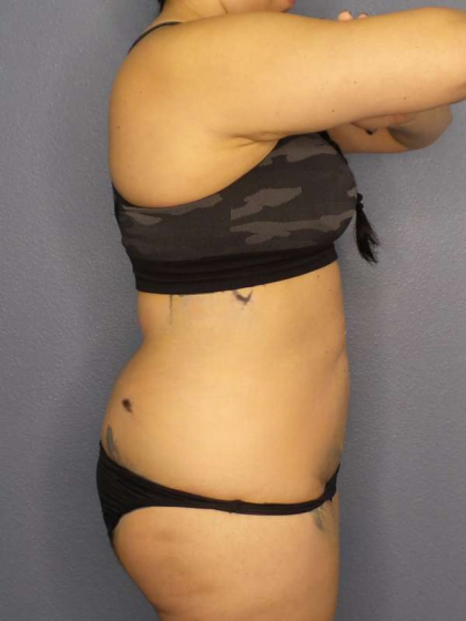Liposuction Female Before & After Patient #8035
