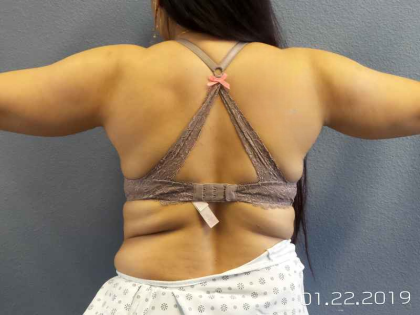 Liposuction Female Before & After Patient #7951