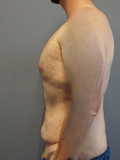 Male Liposuction Before & After Patient #3808