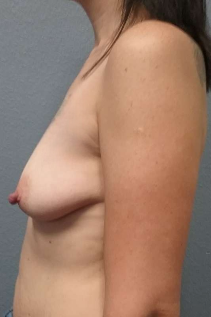 Breast Augmentation Before & After Patient #6749