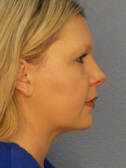 Liposuction of the Neck Before & After Patient #12051