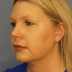 Liposuction of the Neck Before & After Patient #12051