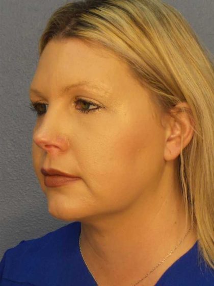 Liposuction of the Neck Before & After Patient #12051
