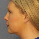 Liposuction of the Neck Before & After Patient #12051