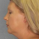 Liposuction of the Neck Before & After Patient #12051
