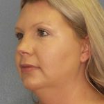 Liposuction of the Neck Before & After Patient #12051