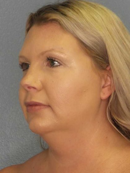 Liposuction of the Neck Before & After Patient #12051