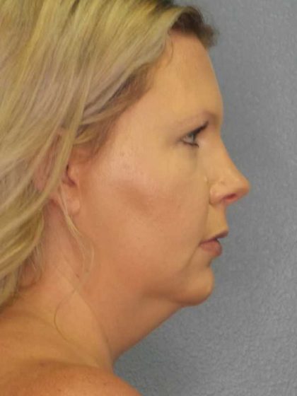 Liposuction of the Neck Before & After Patient #12051