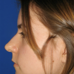 Rhinoplasty Before & After Patient #13456