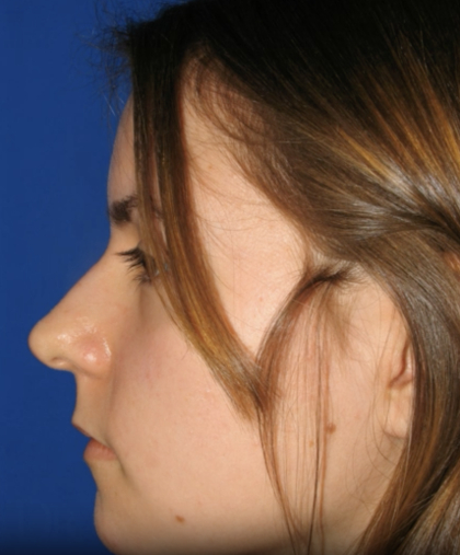Rhinoplasty Before & After Patient #13456