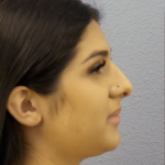 Rhinoplasty Before & After Patient #13455