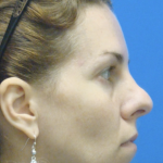 Rhinoplasty Before & After Patient #13457