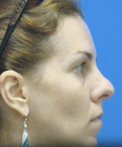 Rhinoplasty Before & After Patient #13457