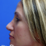 Rhinoplasty Before & After Patient #13458
