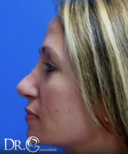 Rhinoplasty Before & After Patient #13458