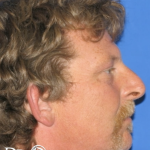 Rhinoplasty Before & After Patient #13460