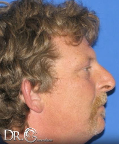 Rhinoplasty Before & After Patient #13460