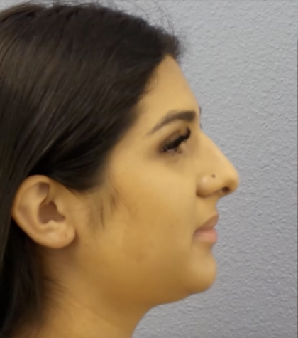 Rhinoplasty Before & After Patient #13455