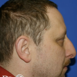 Rhinoplasty Before & After Patient #13462