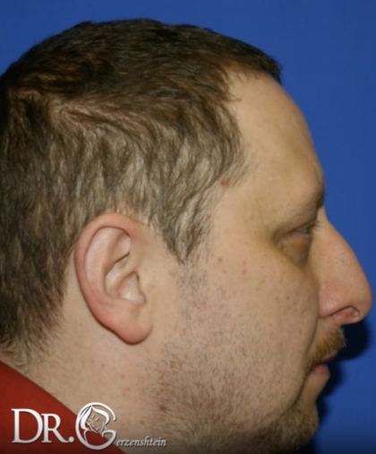 Rhinoplasty Before & After Patient #13462