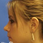 Rhinoplasty Before & After Patient #13456