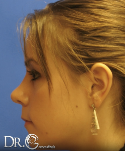 Rhinoplasty Before & After Patient #13456