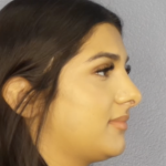 Rhinoplasty Before & After Patient #13455