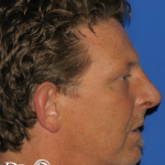 Rhinoplasty Before & After Patient #13460