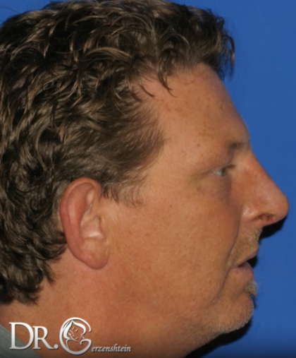 Rhinoplasty Before & After Patient #13460
