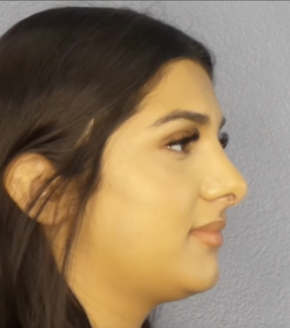 Rhinoplasty Before & After Patient #13455