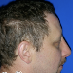 Rhinoplasty Before & After Patient #13462