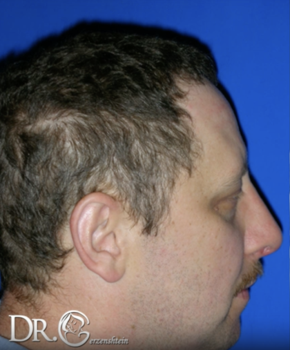 Rhinoplasty Before & After Patient #13462