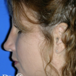 Rhinoplasty Before & After Patient #13463